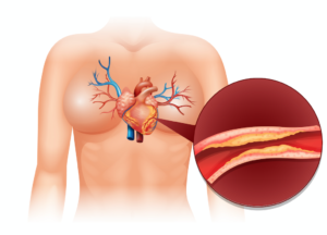 Ilustración de una arteria